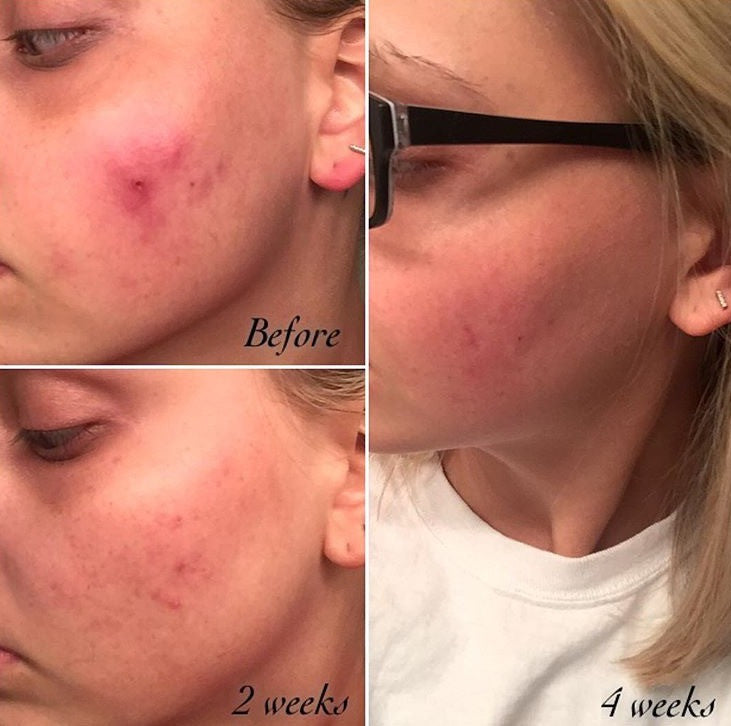 Before and after results using 3-Step Acne System showing clearer skin over 4 weeks.