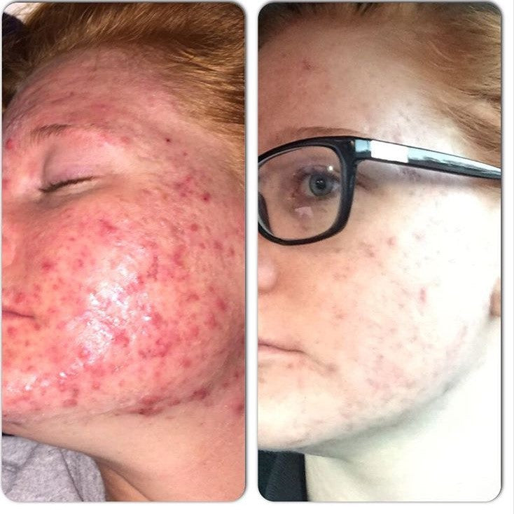 Before and after results using 3-Step Acne System for clearer skin.