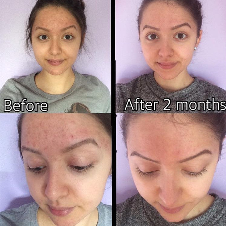 Before and after 2 months results using 3-Step Acne System for natural acne treatment and clearer skin.