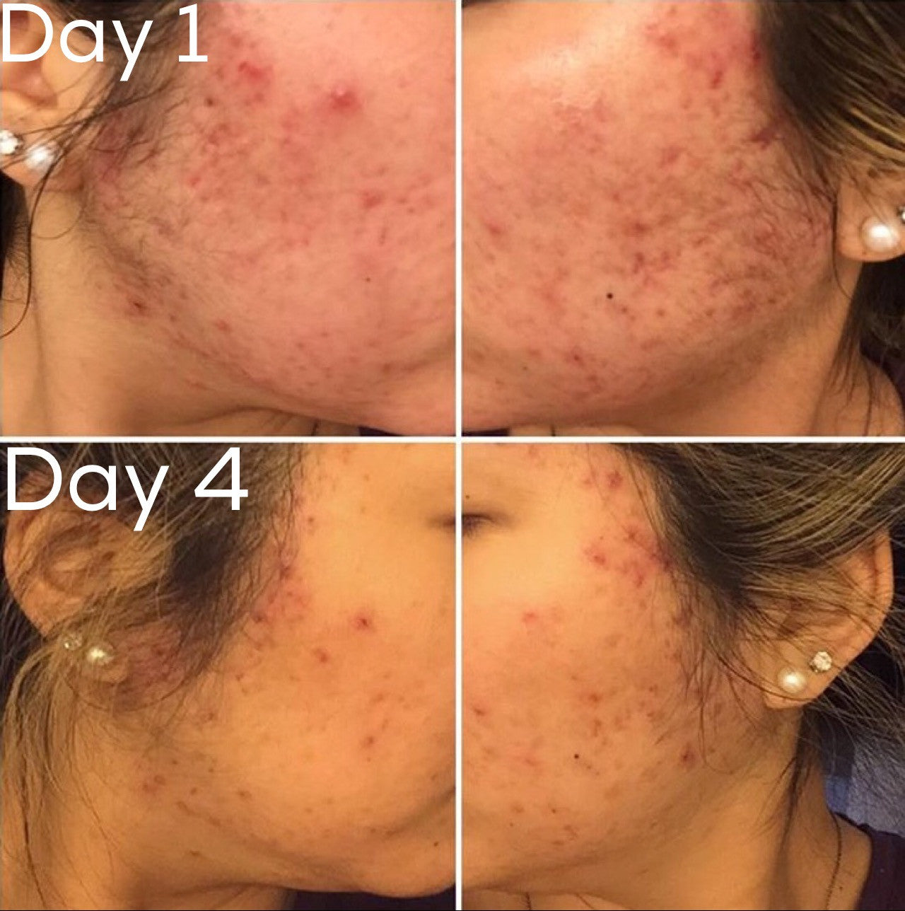 Before and after results with 3-Step Acne System on acne-prone skin over four days, showing significant improvement.