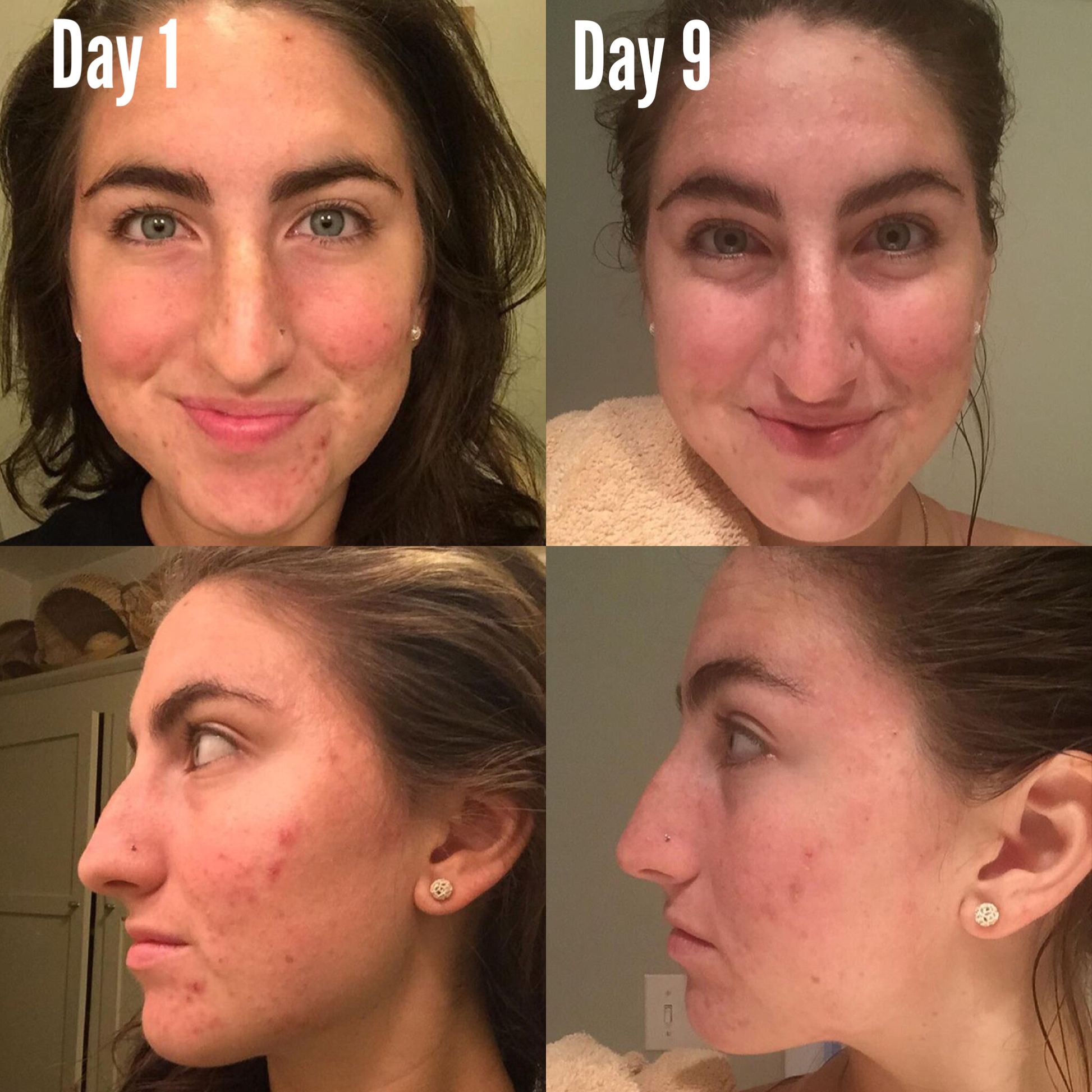 Before and after results using the 3-Step Acne System, showcasing clear, healthy skin transformation.