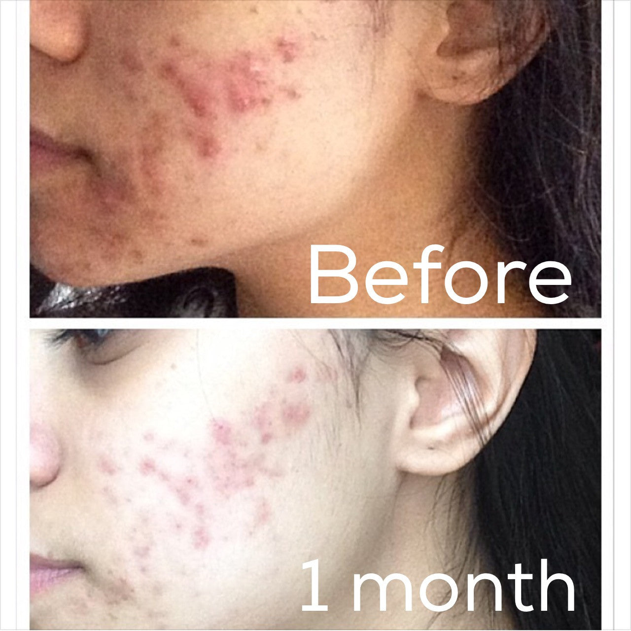Before and after results with 3-Step Acne System showing one month progress on acne-prone skin.